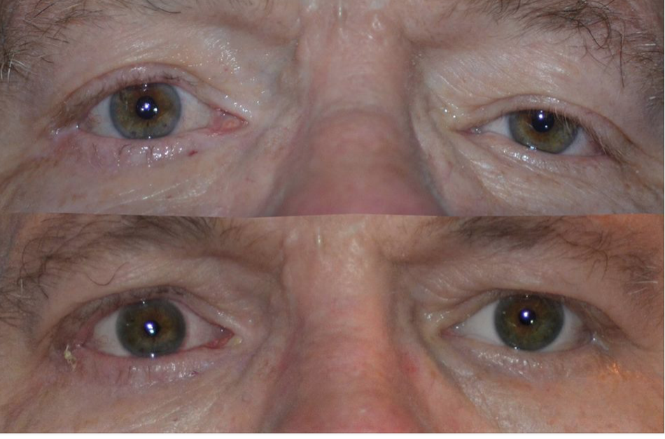 Denver Eyelid Surgery Blepharoplasty Denver Eyebag Treatment