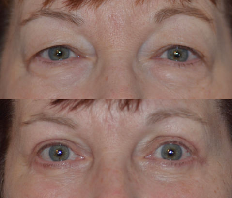 Denver upper and lower eyelid blepharoplasty before and after photo
