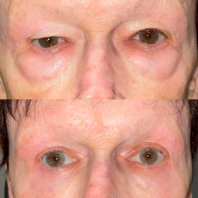 After comprehensive upper and lower eyelid lift in Denver showing improved definition and youthful contour around the eyes.