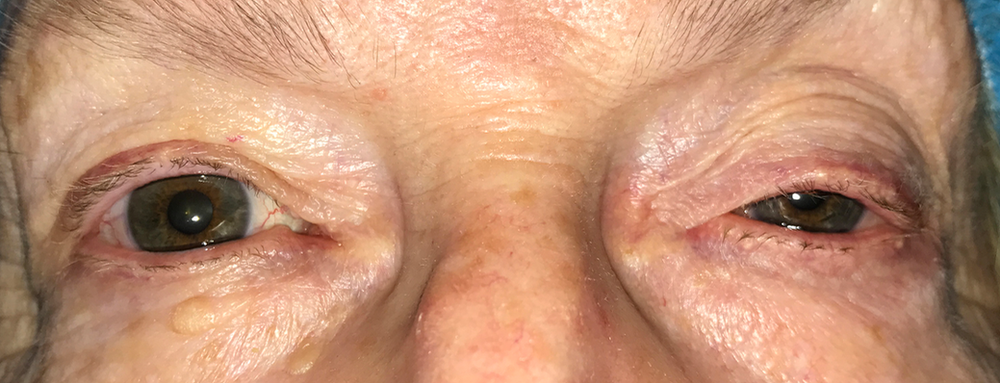 Eyelid lifting covered by insurance The inside scoop