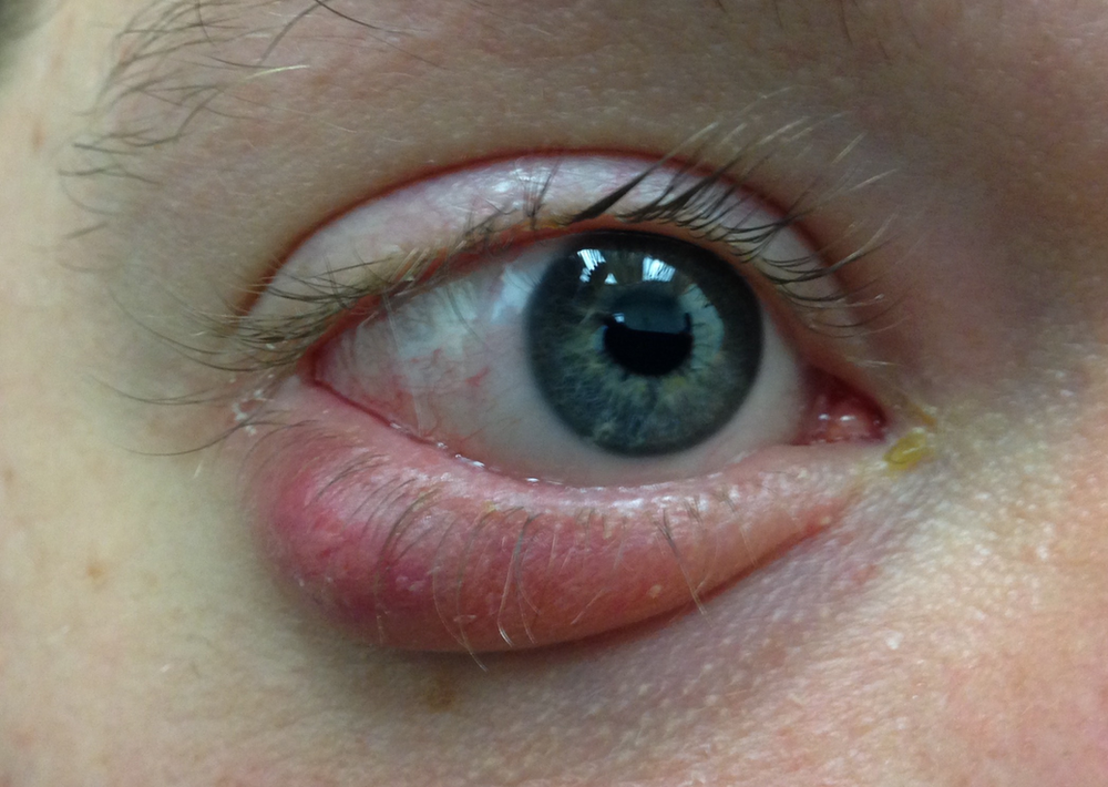 Denver Stye (Chalazion) Fast Facts