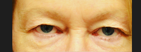 When does insurance cover eyelid lifting surgery?: Update in 2019