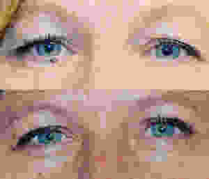 Before and After eyelid surgery