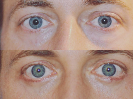 Cosmetic Eyelid Surgery in 2019: What is important to know for Blepharoplasty