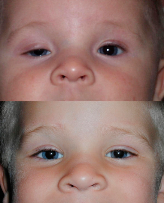 How to fix a Child's drooping eyelid