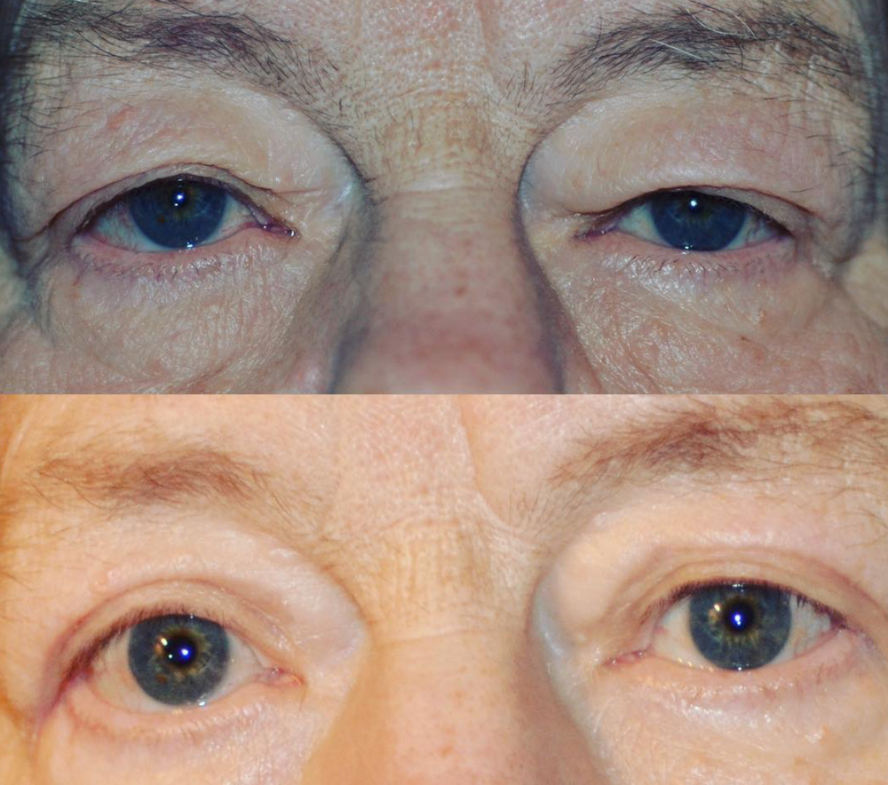 What the different types of cosmetic eyelid surgery?