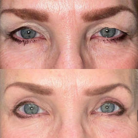 Before and after upper eyelid blepharoplasty in Denver by Dr. Chris Thiagarajah MD
