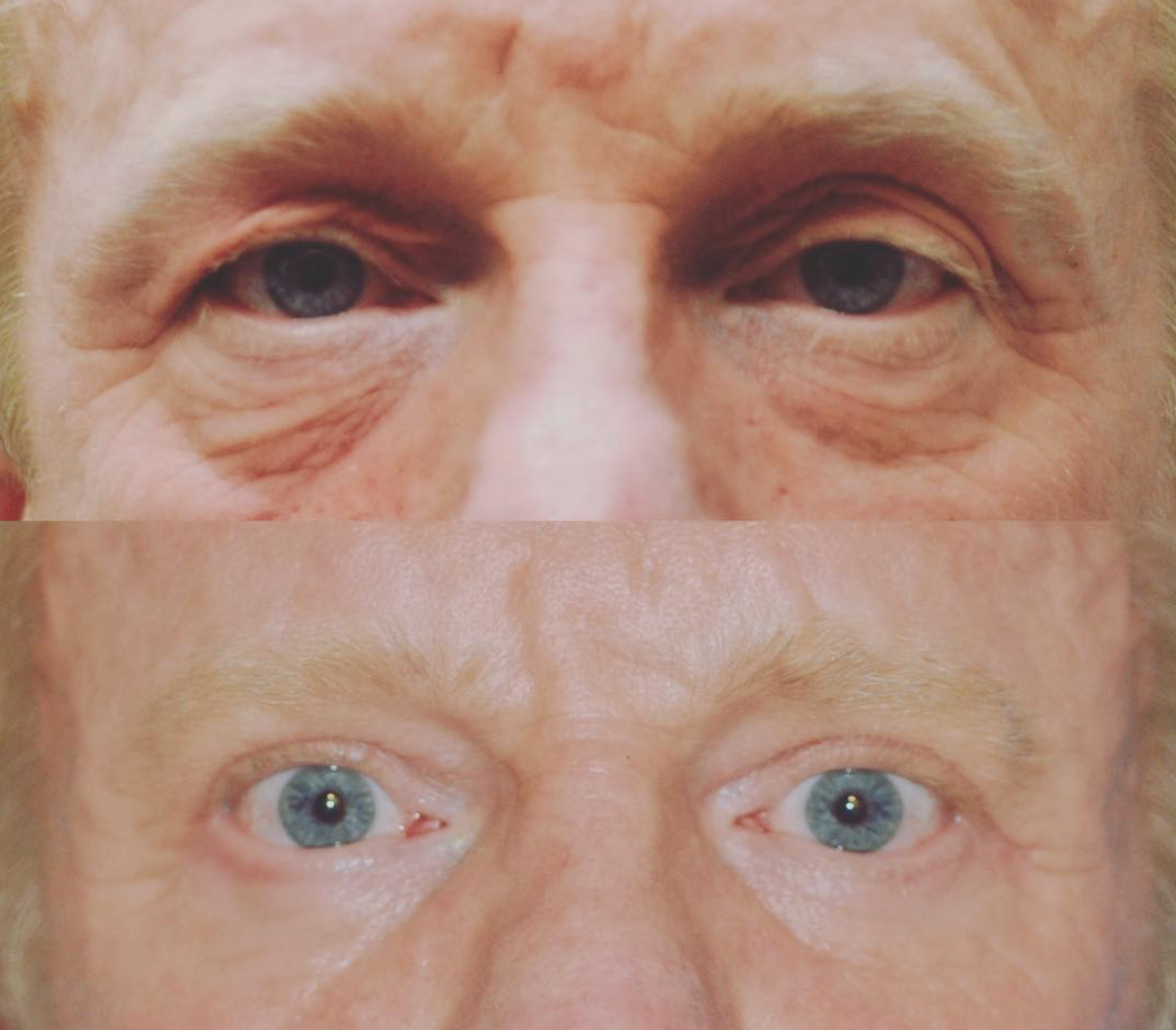 Denver Eyelid Surgery Blepharoplasty Denver Oculoplastic Surgeon