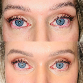 Eye bag removal with lower eyelid blepharoplasty by Denver eyelid surgeon