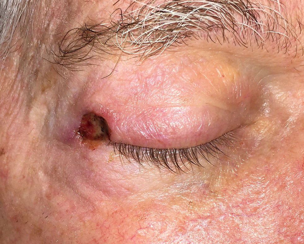 Eyelid Cancer Defect