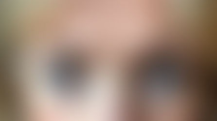 Upper Eyelid Blepharoplasty in Denver, Colorado: Complete Surgeon’s Guide