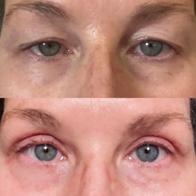 Denver upper eyelid surgery for sagging skin performed by Dr. Thiagarajah