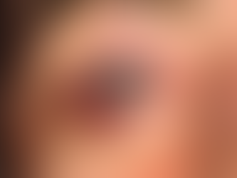 Eyelid Cancer Treatment in Denver