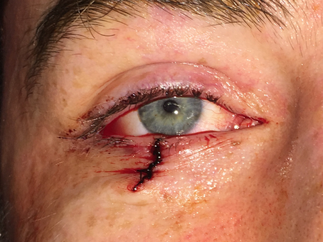 Eyelid Cancer Treatment in Denver