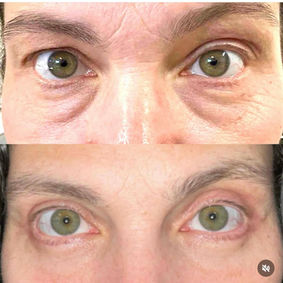 After quad blepharoplasty by Dr. Chris Thiagarajah in Denver with smoother, lifted upper lids and reduced under-eye bags.
