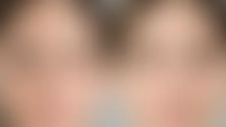 Ptosis Correction Versus Browpexy Compared