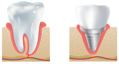 WDS_D_ImplantIllustration.png