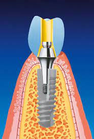 Dental implant Ankylos German implant side view in bone