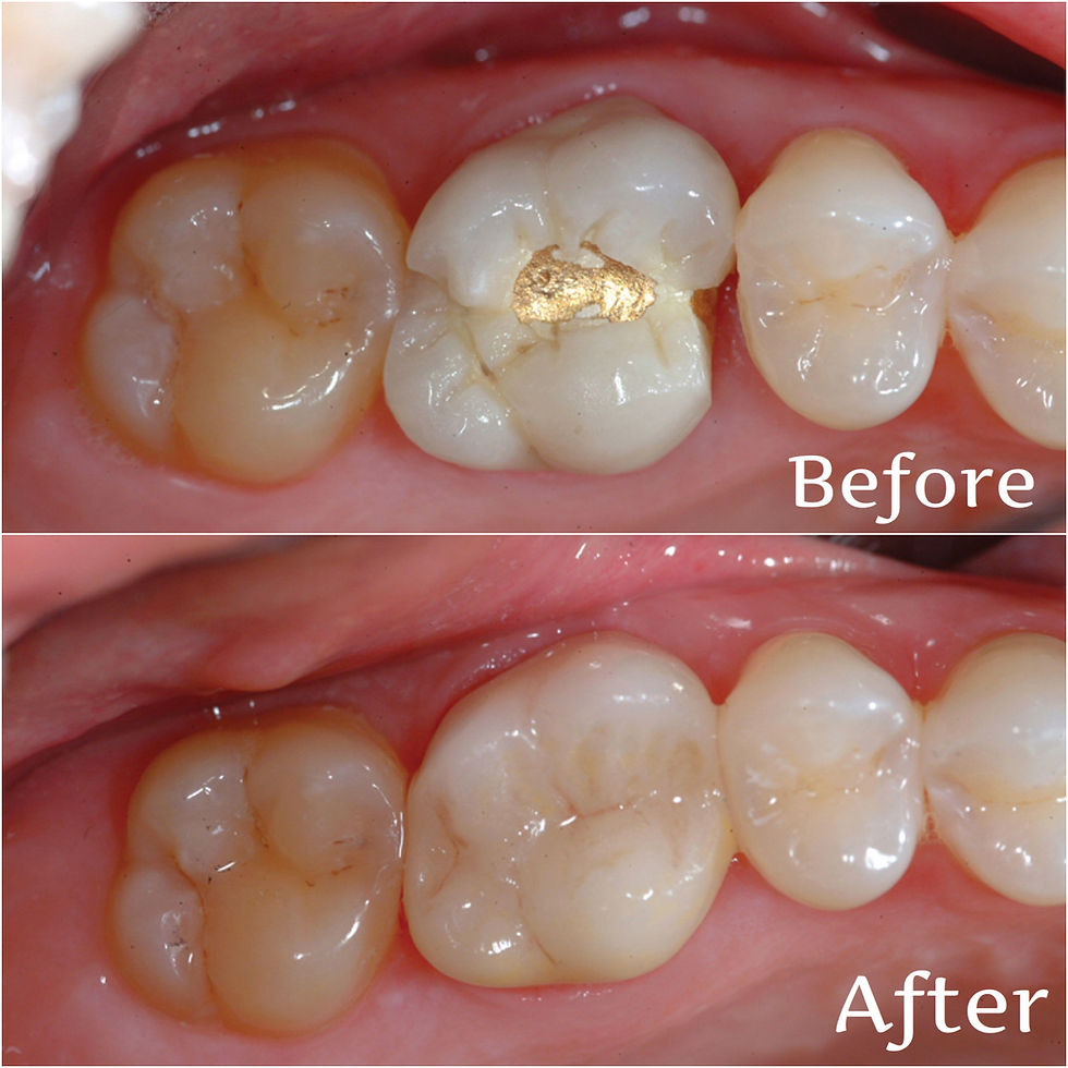 CEREC restoration, 1-visit crown, bridge, CADCAM