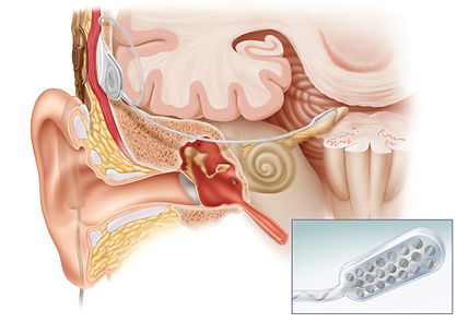 Cochlear ABI electrode