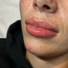 Natural lip filler treatment