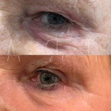 Eye treatment before and afters treatments include, plasma pen, fibroblast, IPL and laser.