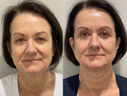 Aesthetic treatment before and after results, including Botox, fillers, microneedling, chemical peels, and radiofrequency treatments