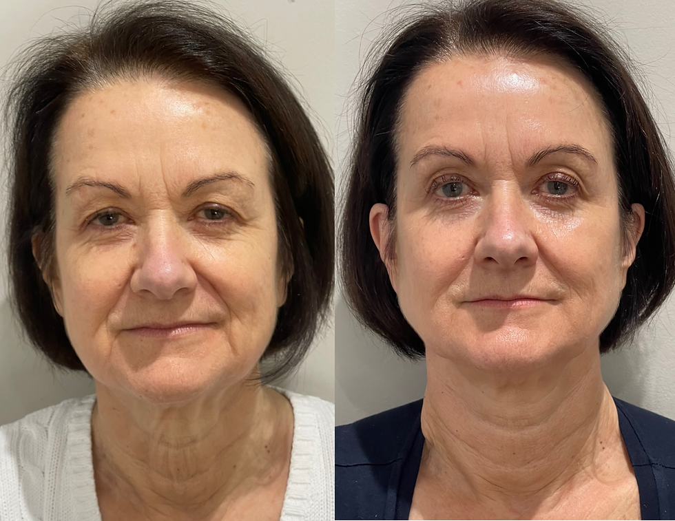 Eye-level view of a skincare professional performing microneedling on a patient’s face