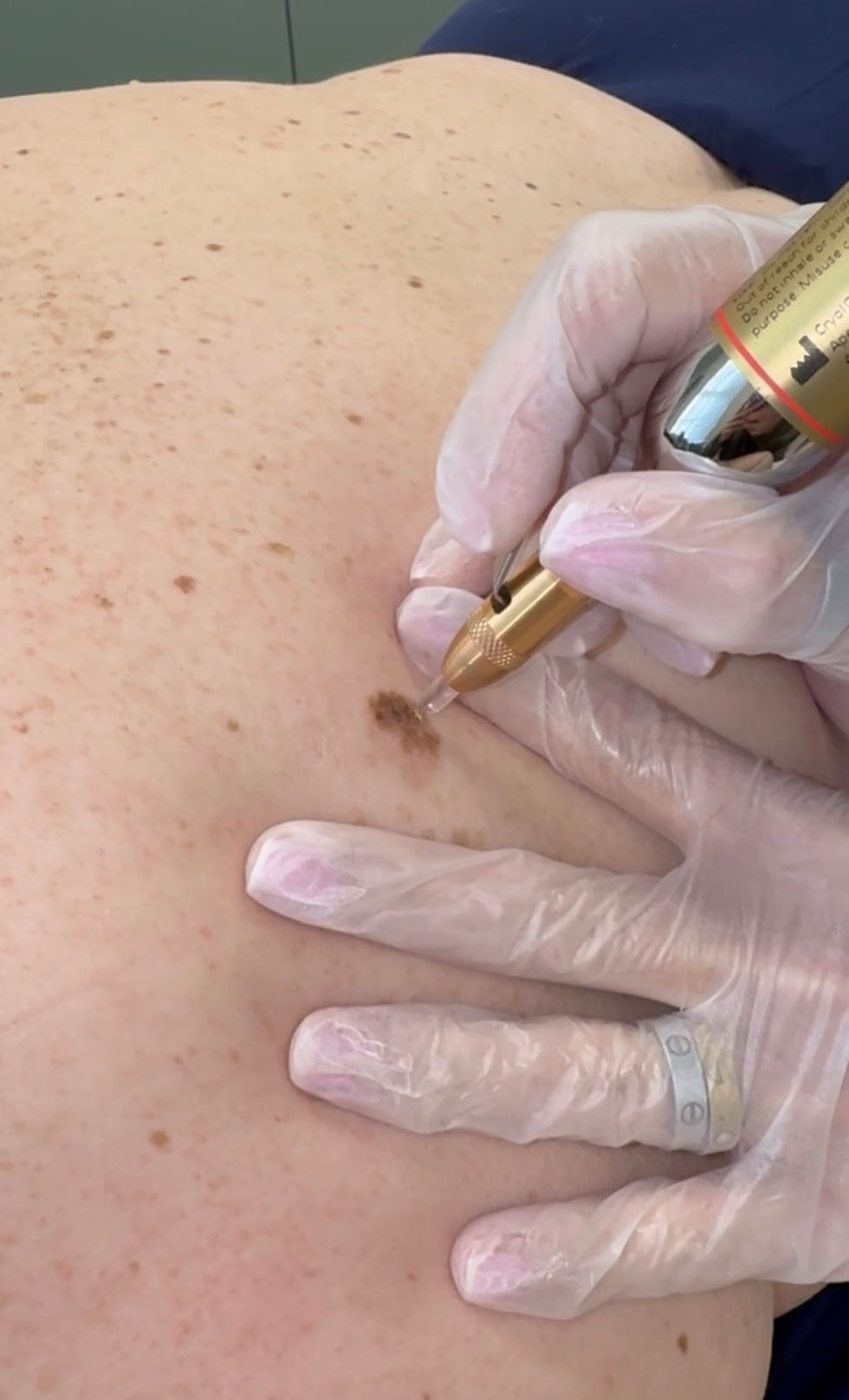 Eye-level view of a skincare professional performing microneedling on a patient’s face