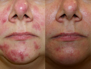 Acne treatment before and after results. Treatment plan includes chemical peels, LED light facials and micro needling 