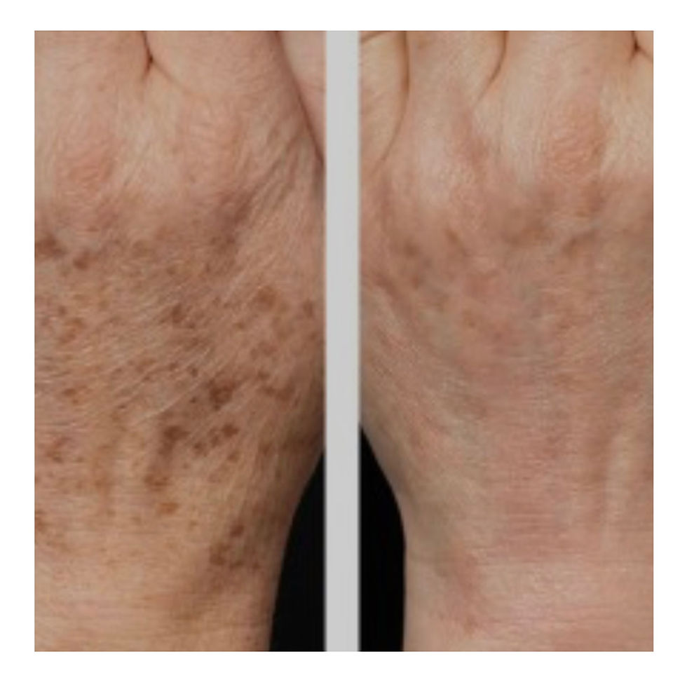 High angle view of glowing, smooth skin after microneedling treatment