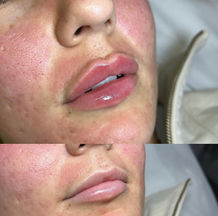 Natural lip filler treatment