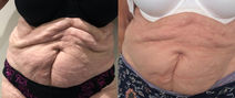 Stomach fat reduction results using cavitation for ft reduction, fat freezing for fat loss, radiofrequency for skin tightening and micro needling
