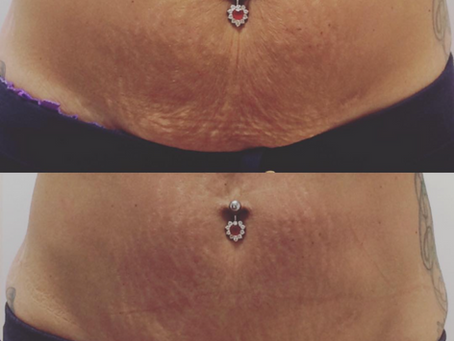 HIFU: The Non-Surgical Lift That's Changing the Way We Age