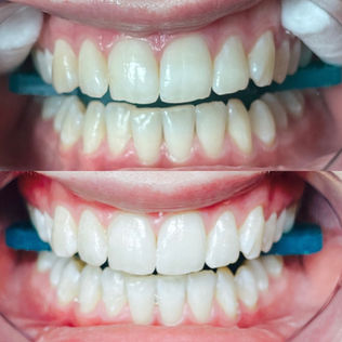 Before and after teeth whitening