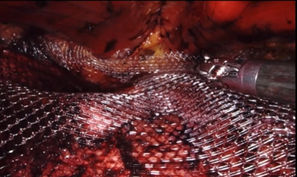 أحدث تقنية لإصلاح الفتاق بأنواعه بالمنظار