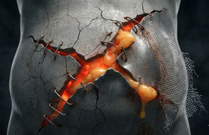 الفتق المتكرر والسمنة: لماذا تفشل الشبكة ويستمر الألم؟ الحل الجذري لإعادة بناء جدار البطن