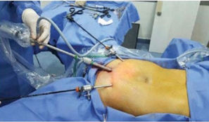 هل يمكن شد عضلات البطن بالمنظار ؟