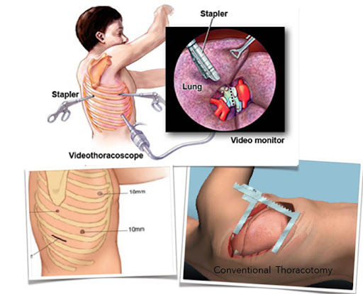 VATS Videoscopic Thoracic Surgery