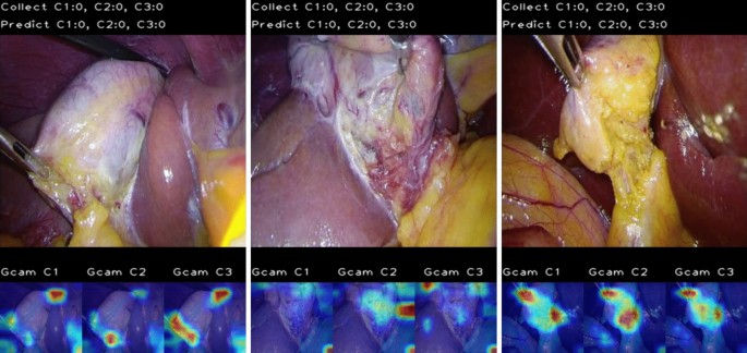 AI Improving safety in cholecystectomy