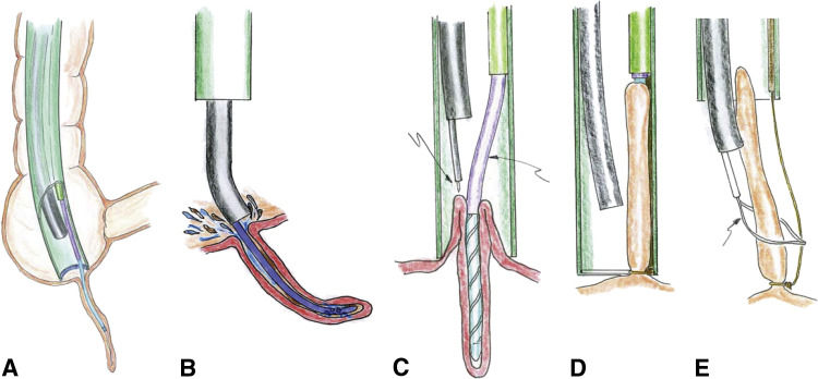 Appendix inversion and removal