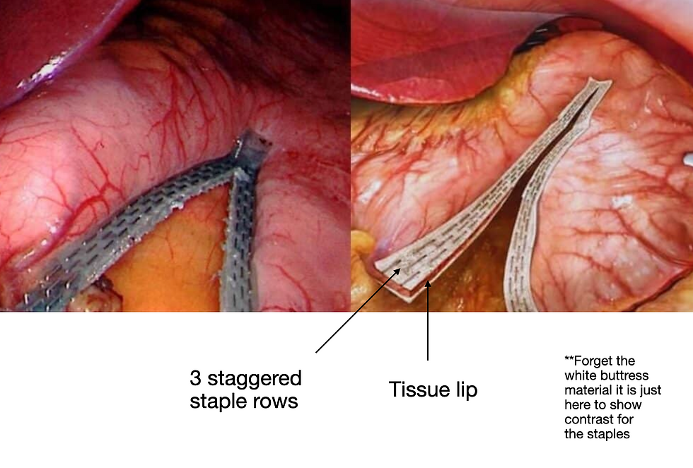 Anatomy of a surgical staple line