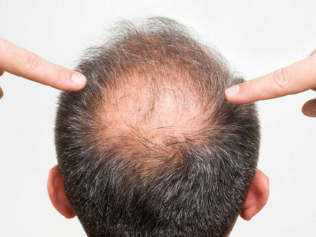 Hair Regrowth Treatment in Bangalore