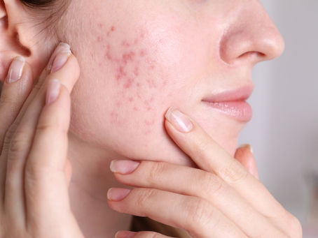 Acne Scar Treatment Specialists in Jayanagar – SkinXperts