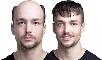 Hair Fixing Center in Bangalore - Flair Hair Fixing