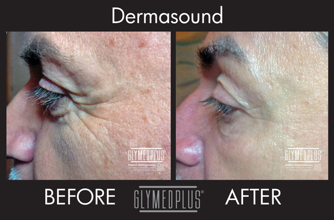 dermasound facial near me