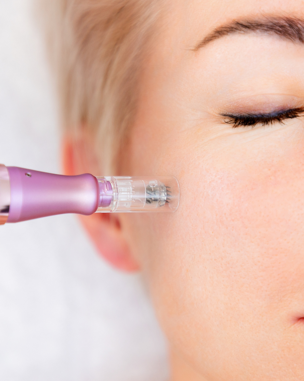 Microneedling