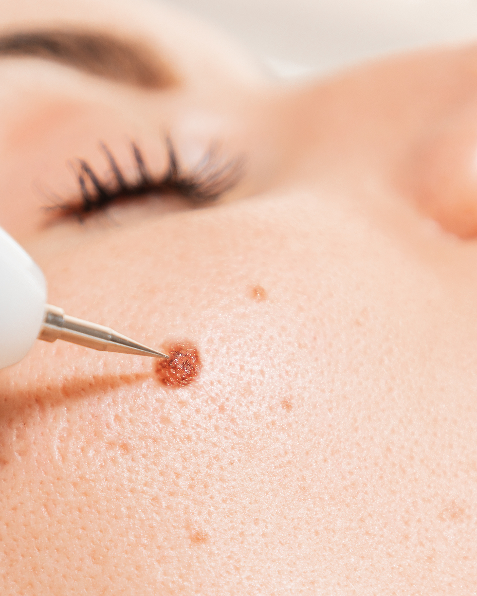 Cryotherapy Blemish Removal