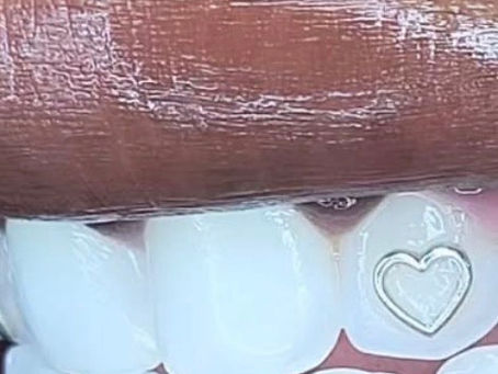 The Essential Guide to Dental Veneers: Dental Veneer Definition and Weighing the Pros and Cons