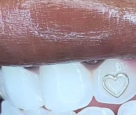 The Essential Guide to Dental Veneers: Dental Veneer Definition and Weighing the Pros and Cons